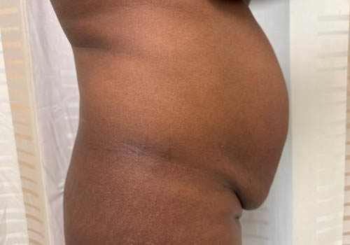 Tummy Tuck