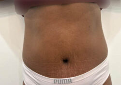 Tummy Tuck