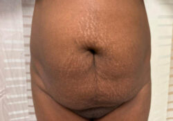 Tummy Tuck