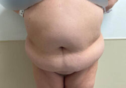 Tummy Tuck
