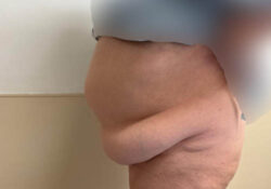Tummy Tuck