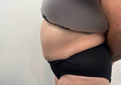 Tummy Tuck