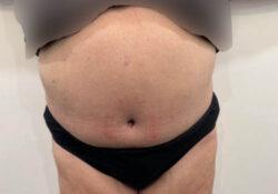 Tummy Tuck