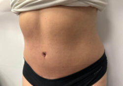 Tummy Tuck