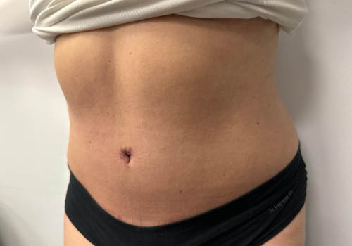 Tummy Tuck