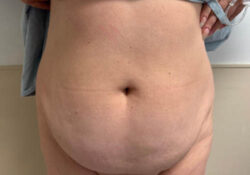 Tummy Tuck