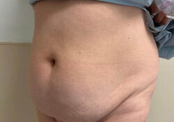 Tummy Tuck