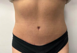 Tummy Tuck