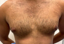 Male Breast Reduction