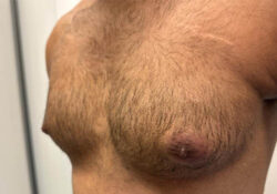 Male Breast Reduction