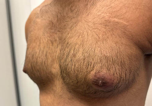 Male Breast Reduction