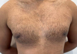 Male Breast Reduction