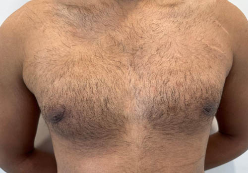 Male Breast Reduction Case 27871 After Photo Male Breast Reduction