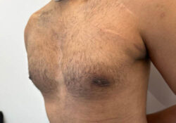 Male Breast Reduction