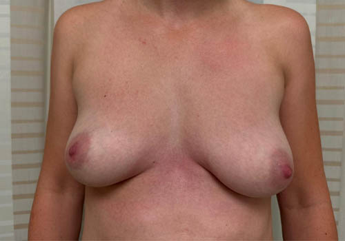 Breast Augmentation Case 27876 Before Photo Breast Augmentation