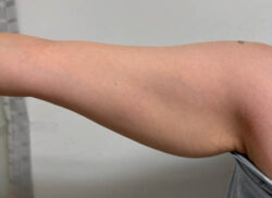 Arm Lift