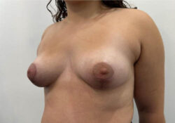 Breast Lift