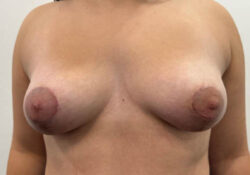 Breast Lift
