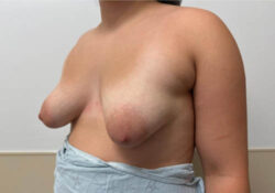 Breast Lift