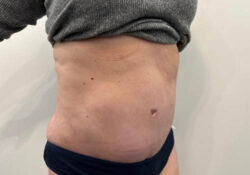 Tummy Tuck