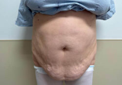 Tummy Tuck
