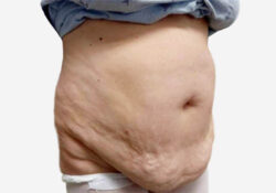 Tummy Tuck