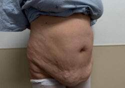Tummy Tuck