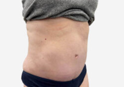 Tummy Tuck