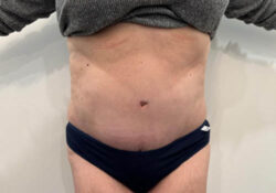 Tummy Tuck