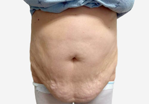 Tummy Tuck