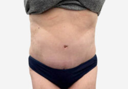 Tummy Tuck