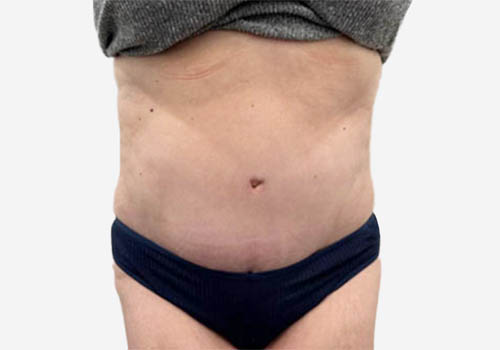 Tummy Tuck