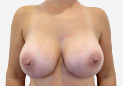 Breast Augmentation