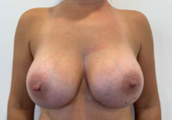 Breast Augmentation