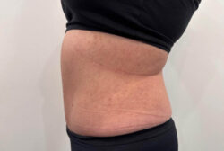Tummy Tuck