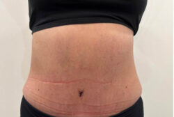 Tummy Tuck
