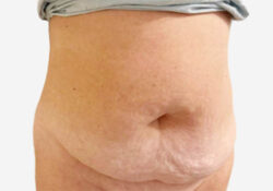 Tummy Tuck