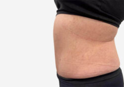 Tummy Tuck