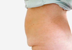 Tummy Tuck
