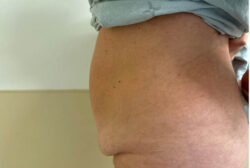 Tummy Tuck