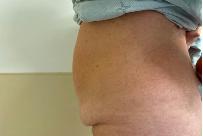 Tummy Tuck