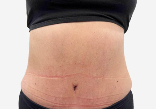 Tummy Tuck Case 31307 After Photo Tummy Tuck