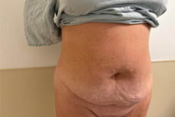 Tummy Tuck