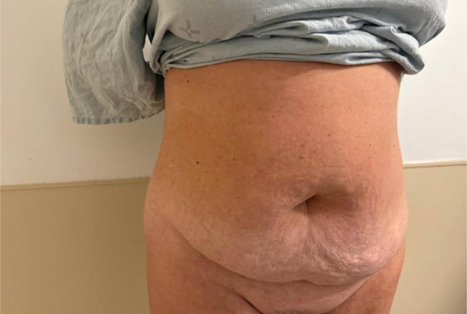 Tummy Tuck Case 31307 Before Photo Tummy Tuck