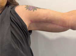Arm Lift