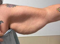 Arm Lift