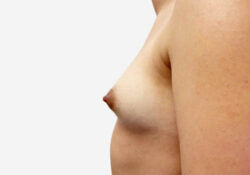 Breast Augmentation