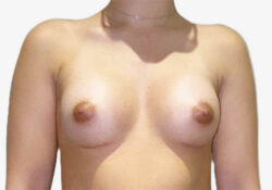 Breast Augmentation