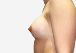 Breast Augmentation