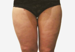 Liposuction